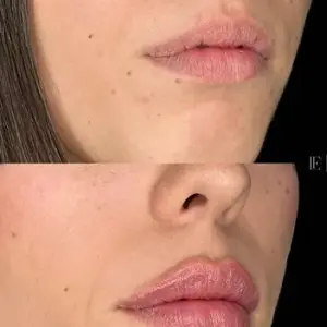 Aumento Labial Ácido Hialurónico - Técnica  Aumento Vertical