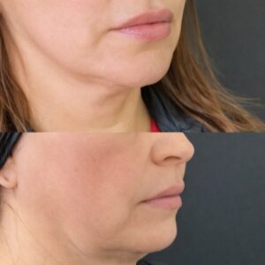Lipo Papada Enzimática con Ácido Desoxicolico