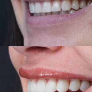 Blanqueamiento dental + limpieza profunda