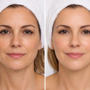 Masculinización Facial